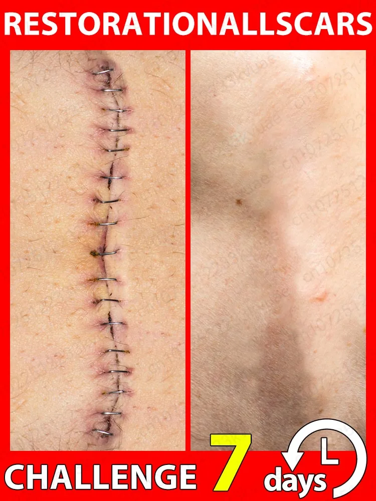Scar Removal Cream Scar Repair Gel Fade Scars Burns Caesarean Section Stretch Marks Surgical Scars Hyperplasia Scars
Scar Removal Cream Scar Repair Gel Fade Scars Burns Caesarean Section Stretch Marks Surgical Scars Hyperplasia Scars