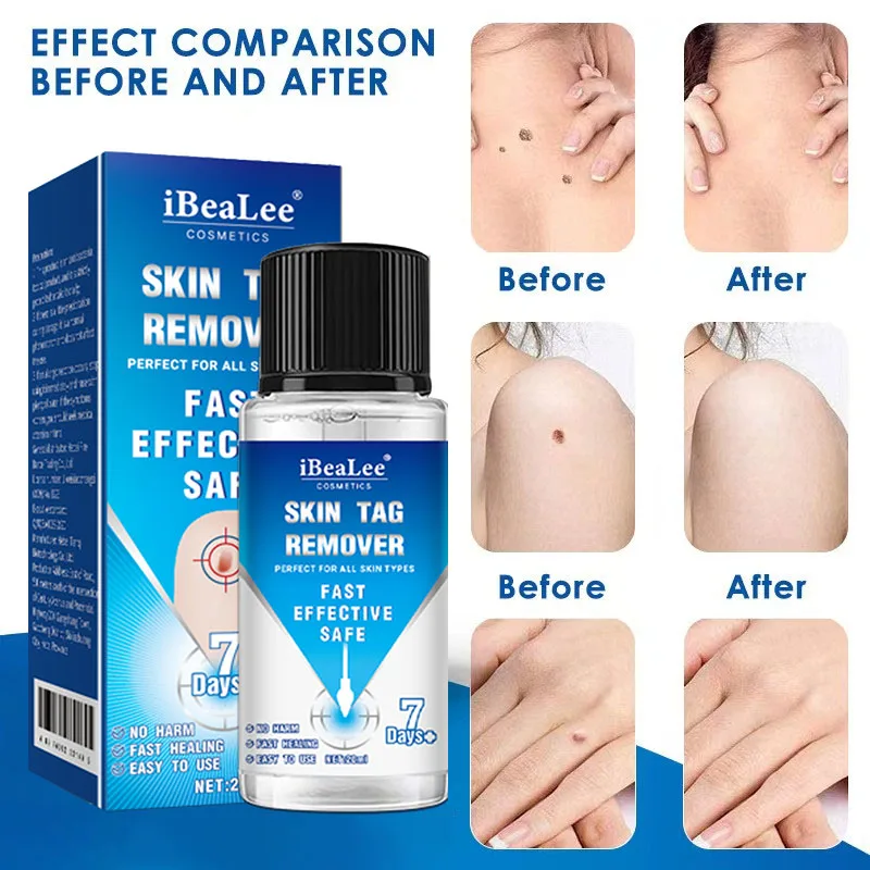 iBeaLee Skin Tag Remover Serum Painless 7Days Removal Dark Spot Mole Warts Freckle Face Flat Wart Cream Treatment Essential Oil
iBeaLee Skin Tag Remover Serum Painless 7Days Removal Dark Spot Mole Warts Freckle Face Flat Wart Cream Treatment Essential Oil