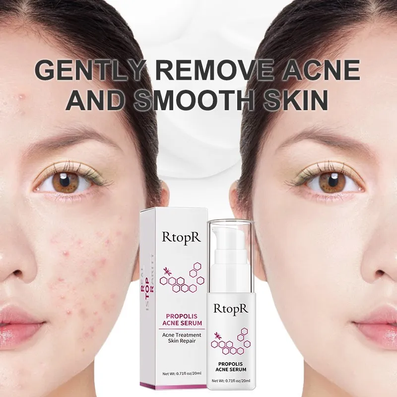 Propolis Repair Acne Serum Skin Brightening Care Acne Scar Spots Cleaning Serum Shrink Pores Eliminates Oil control Treatment
Propolis Repair Acne Serum Skin Brightening Care Acne Scar Spots Cleaning Serum Shrink Pores Eliminates Oil control Treatment