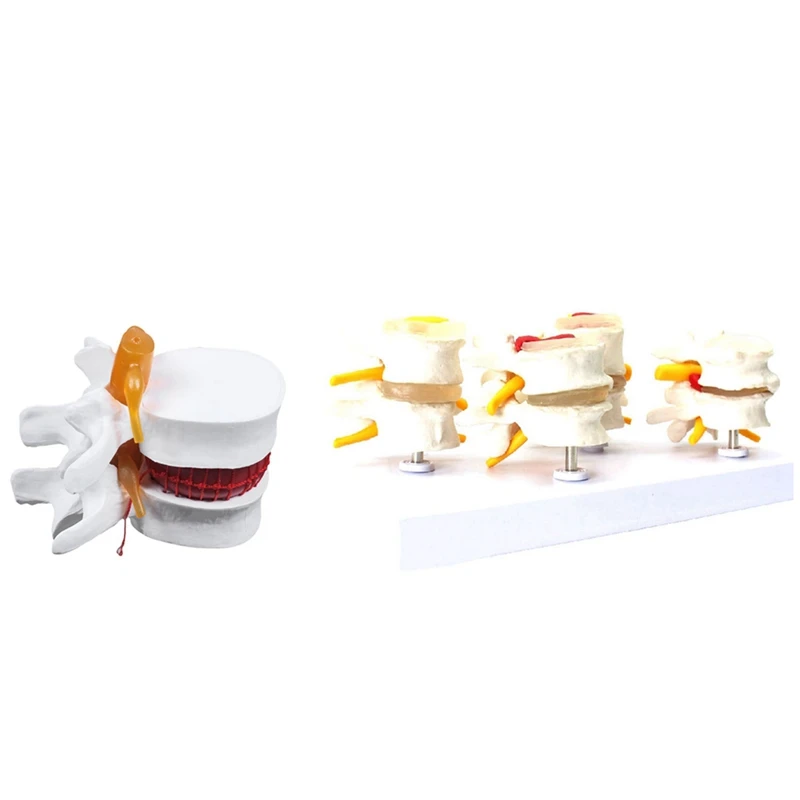 1 Pcs Skeleton Spine Lumbar Disc Herniation Teaching Model & 1 Pcs Human Anatomy Skeleton Spine Vertebral Model
1 Pcs Skeleton Spine Lumbar Disc Herniation Teaching Model & 1 Pcs Human Anatomy Skeleton Spine Vertebral Model