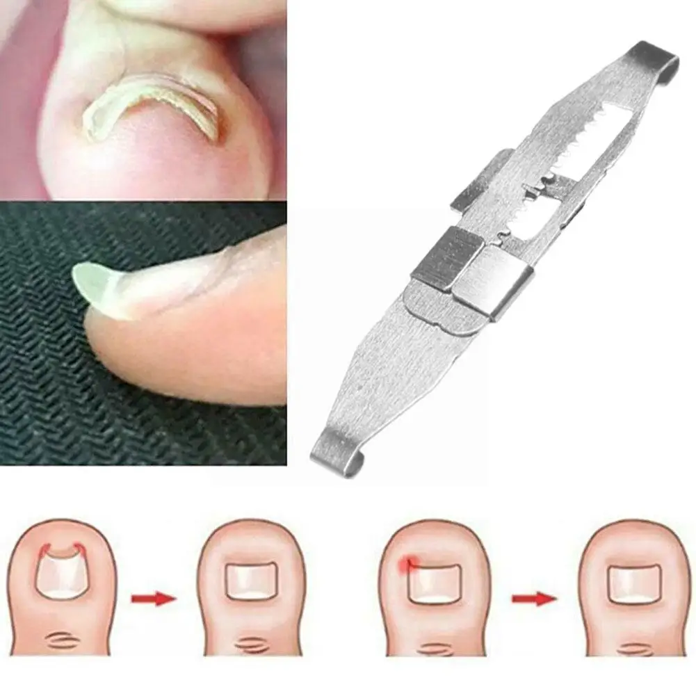 Ingrown Toenails Correction Pedicure Foot Toe Nail Straightening Brace Nail Toe Clip Tools Ingrown Care Fixer Corrector C2w5
Ingrown Toenails Correction Pedicure Foot Toe Nail Straightening Brace Nail Toe Clip Tools Ingrown Care Fixer Corrector C2w5