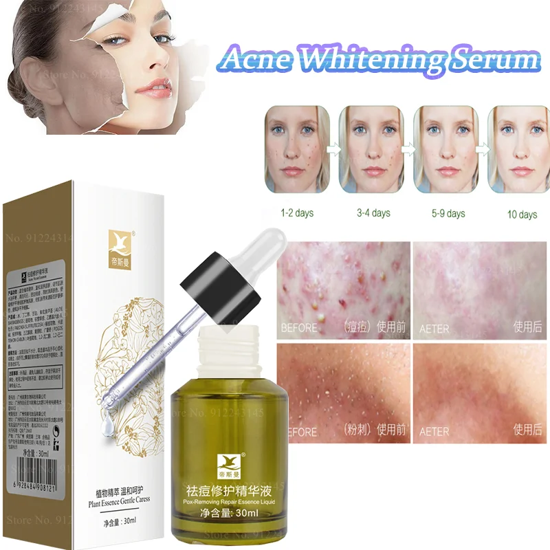 The New Acne-removing Essence Repairs Whitening, Acne-removing Marks, Fades Scars, and Acne Pits Essence for Men and Women
The New Acne-removing Essence Repairs Whitening, Acne-removing Marks, Fades Scars, and Acne Pits Essence for Men and Women