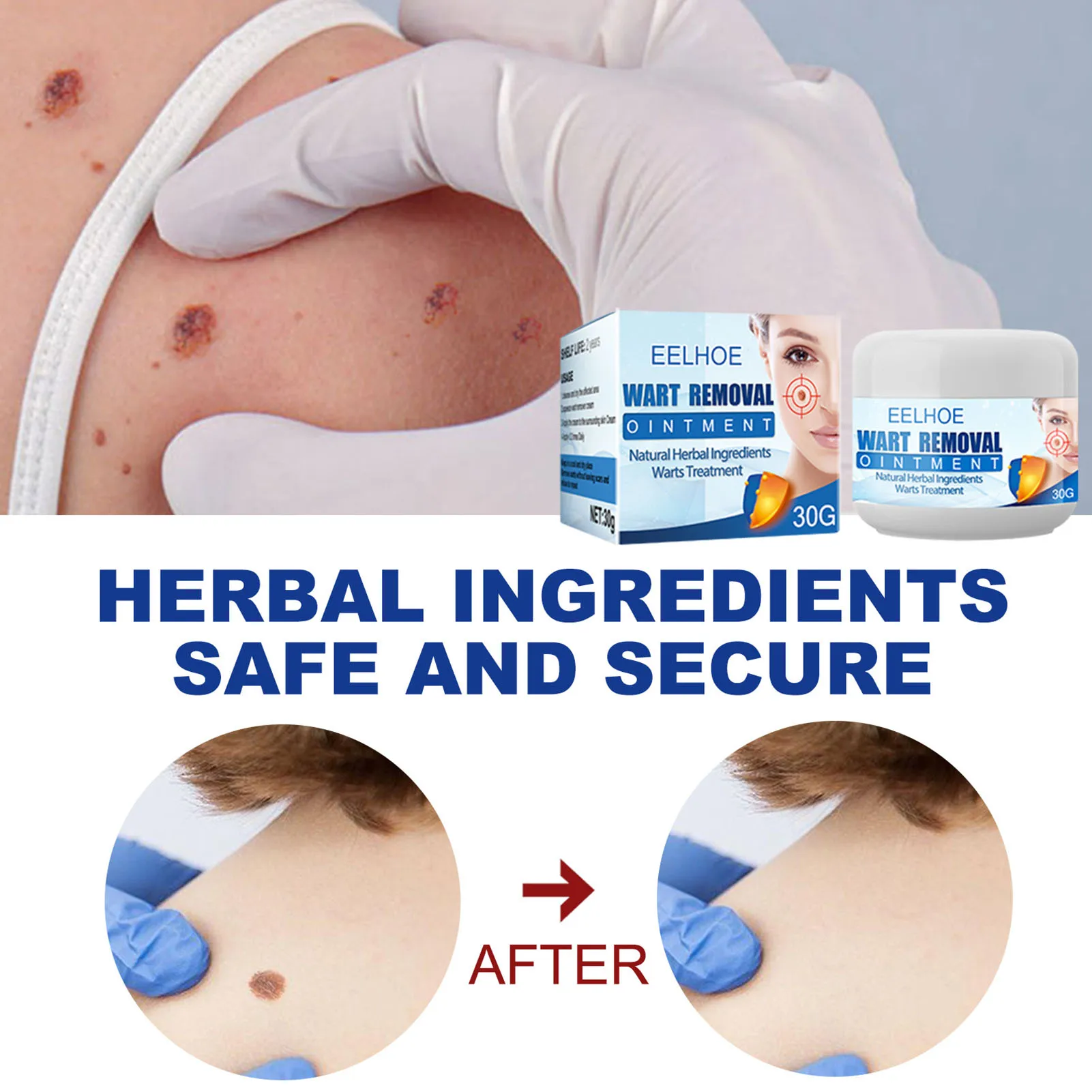 Крем для удаления бородавок и бородавок на ногах, 30 г
Крем для удаления бородавок и бородавок на ногах, 30 г