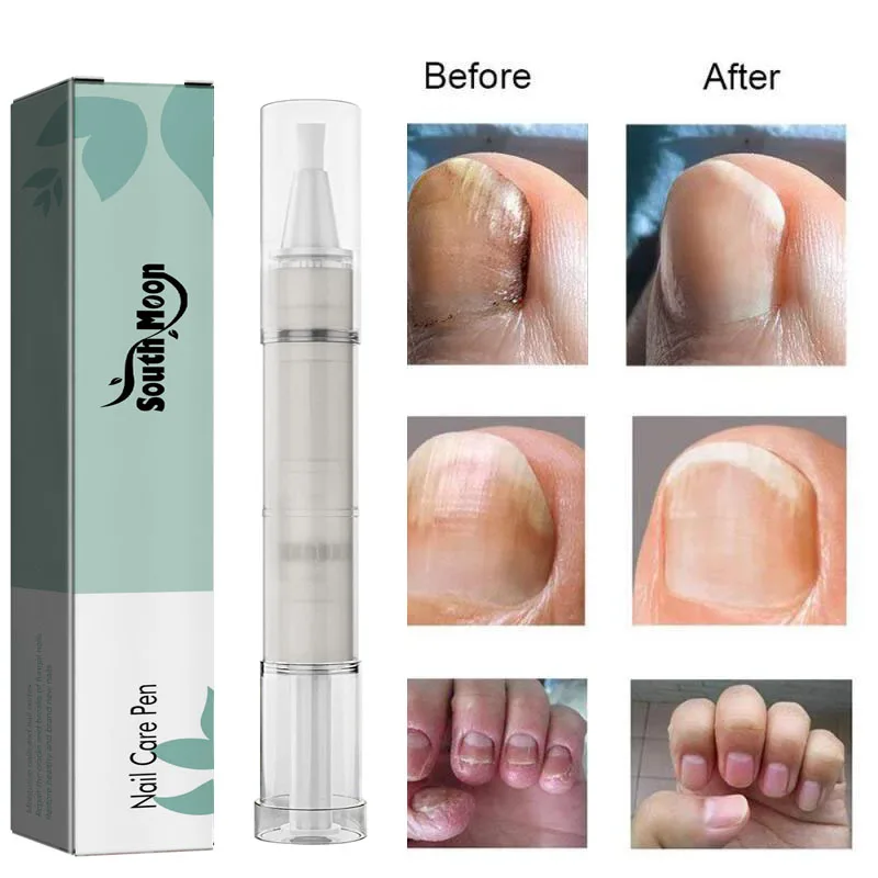 Травяная восстанавливающая сыворотка для ногтей, антиинфекционный гель для онихомикоза, паронихии, безболезненное лечение грибка ногтей, ...
Травяная восстанавливающая сыворотка для ногтей, антиинфекционный гель для онихомикоза, паронихии, безболезненное лечение грибка ногтей, ...