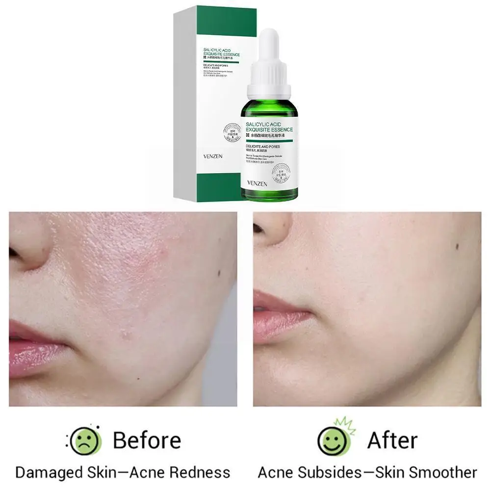 Aloe Salicylic Acid Acne Treatment Serum Oil Control Moisturizing Brighten Improve Face Roughness Essence Shrink Hyaluronic P5g2
Aloe Salicylic Acid Acne Treatment Serum Oil Control Moisturizing Brighten Improve Face Roughness Essence Shrink Hyaluronic P5g2