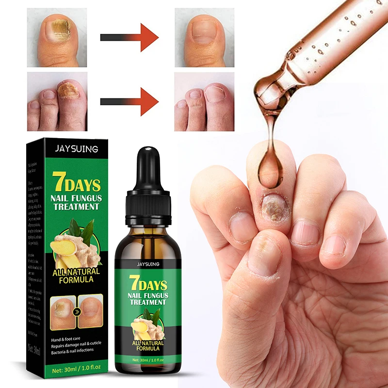 7 Days Ginger Nail Fungal Treatment Feet Care Essence Anti Infection Paronychia Onychomycosis Foot Toe Nail Fungus Removal Gel
7 Days Ginger Nail Fungal Treatment Feet Care Essence Anti Infection Paronychia Onychomycosis Foot Toe Nail Fungus Removal Gel