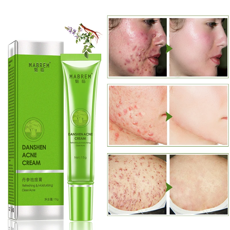 Salvia Acne Treatment Cream Removal Face Blackhead Anti Acne Cream Oil Control Shrink Pores Acne Scar Face Care Whitening
Salvia Acne Treatment Cream Removal Face Blackhead Anti Acne Cream Oil Control Shrink Pores Acne Scar Face Care Whitening