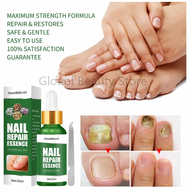 Nail Fungal Repair Essence Serum Anti Fungal Nail Foot Treatment Remove Onychomycosis Gel Anti Infection Nourishing Toes Caremak
Nail Fungal Repair Essence Serum Anti Fungal Nail Foot Treatment Remove Onychomycosis Gel Anti Infection Nourishing Toes Caremak
