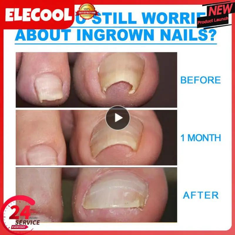Nail Correction Stickers Ingrown Toenail Corrector Patches Paronychia Recover Corrector Pedicure Tools
Nail Correction Stickers Ingrown Toenail Corrector Patches Paronychia Recover Corrector Pedicure Tools