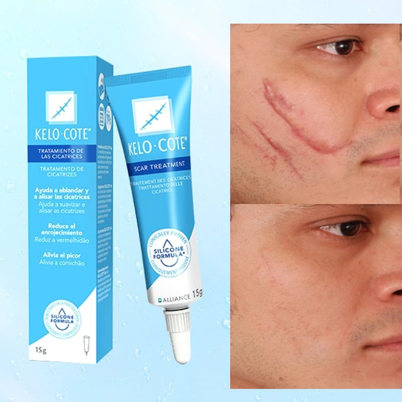 Kelo-cote/ Barker Scar 15 ML Effective Scar Removal Cream Scar Gel Acne Remover Whitening Skin Care Cream Treatment Scar Repair
Kelo-cote/ Barker Scar 15 ML Effective Scar Removal Cream Scar Gel Acne Remover Whitening Skin Care Cream Treatment Scar Repair