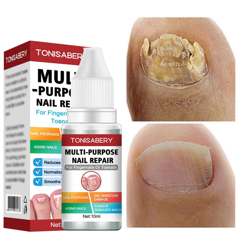 Nail Fungal Treatment Serum Onychomycosis Paronychia Anti Infection Toe Fungus Hand Foot Removal Repair Gel Care Beauty Health
Nail Fungal Treatment Serum Onychomycosis Paronychia Anti Infection Toe Fungus Hand Foot Removal Repair Gel Care Beauty Health