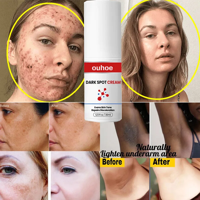 Black Spot Repair Cream for Dull Skin Fade Fine Lines Black Spot Pigments Brighten Whiten Skin Repair Cream Korean Cosmetics
Black Spot Repair Cream for Dull Skin Fade Fine Lines Black Spot Pigments Brighten Whiten Skin Repair Cream Korean Cosmetics