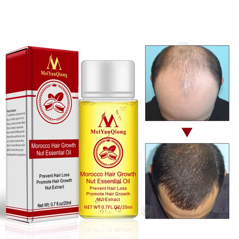 Nuts Hair Fast Powerful Growth Essence Preventing Hair Loss Baldness Liquid Oil Treatment Hair Care Product Repair Shampoo Hair
Nuts Hair Fast Powerful Growth Essence Preventing Hair Loss Baldness Liquid Oil Treatment Hair Care Product Repair Shampoo Hair