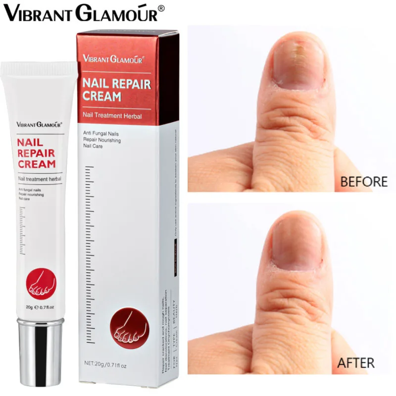 Fungal Nail Treatment Cream Nail Repair Essence Nail Fungus Removal Gel Anti Infection Paronychia Onychomycosis Fungal Nail Care
Fungal Nail Treatment Cream Nail Repair Essence Nail Fungus Removal Gel Anti Infection Paronychia Onychomycosis Fungal Nail Care