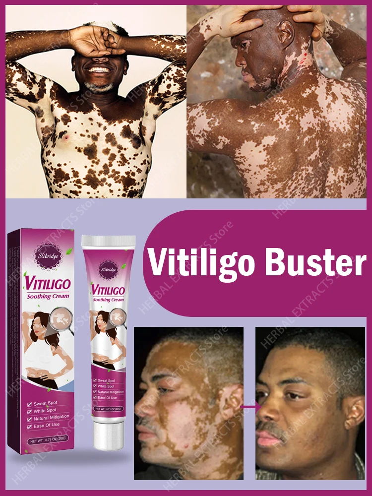 Восстанавливающий Крем Vitiligo, оригинальный отбеливающий крем Vitiligo, прямая атака обесцвечивания, не нужно беспокоиться о коже белой доски
Восстанавливающий Крем Vitiligo, оригинальный отбеливающий крем Vitiligo, прямая атака обесцвечивания, не нужно беспокоиться о коже белой доски