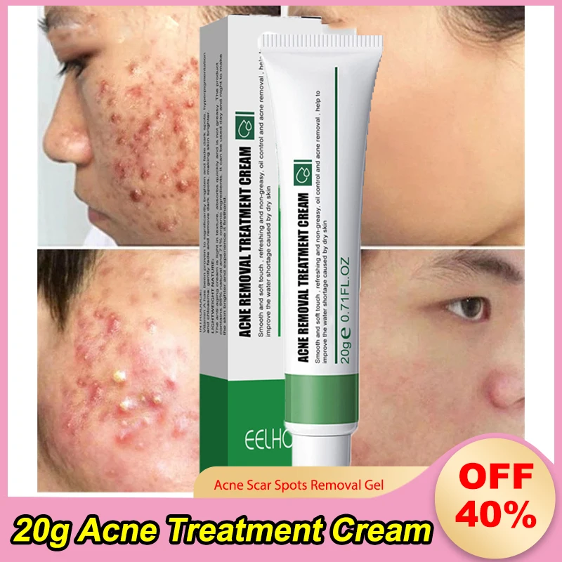 20g Acne Treatment Cream Acne Scar Spots Removal Gel Anti-Acne Oil Control Shrink Pores Whitening Moisturizing Smooth Skin Care
20g Acne Treatment Cream Acne Scar Spots Removal Gel Anti-Acne Oil Control Shrink Pores Whitening Moisturizing Smooth Skin Care
