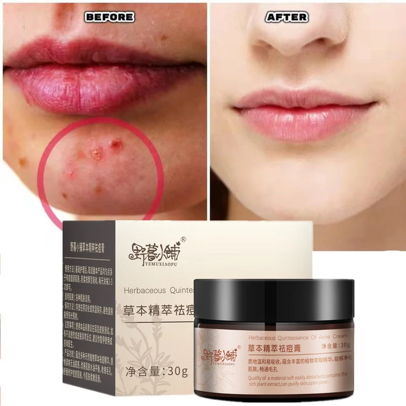 Acne Cream for Acne Skin Care Face Moisturizer Oil Control Pimple Acne Scar Removal Cream Treatment for Women
Acne Cream for Acne Skin Care Face Moisturizer Oil Control Pimple Acne Scar Removal Cream Treatment for Women