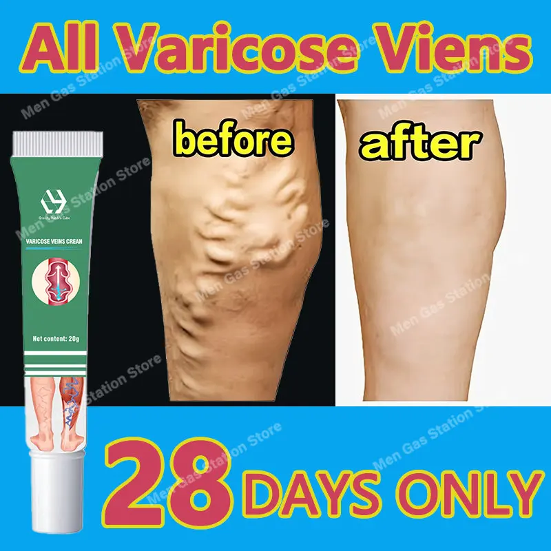 Varicose veins treatment cream varicose veins remedy and effective treatment
Varicose veins treatment cream varicose veins remedy and effective treatment