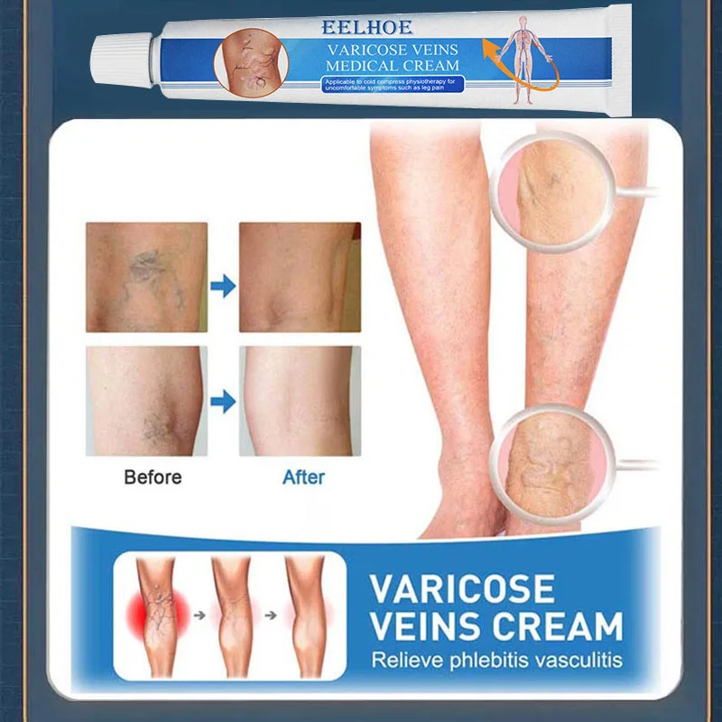 ointment for varicose veins Effective varicose vein relief cream to relieve vasculitis phlebitis spider pain treatment
ointment for varicose veins Effective varicose vein relief cream to relieve vasculitis phlebitis spider pain treatment