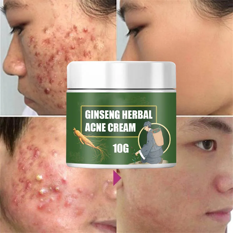 

Acne Cream Removal Acnes Pimples Treatment Acne Scar Shrink Pores Oil Control Whitening Moisturize Ginseng Herb Acne Skin Care