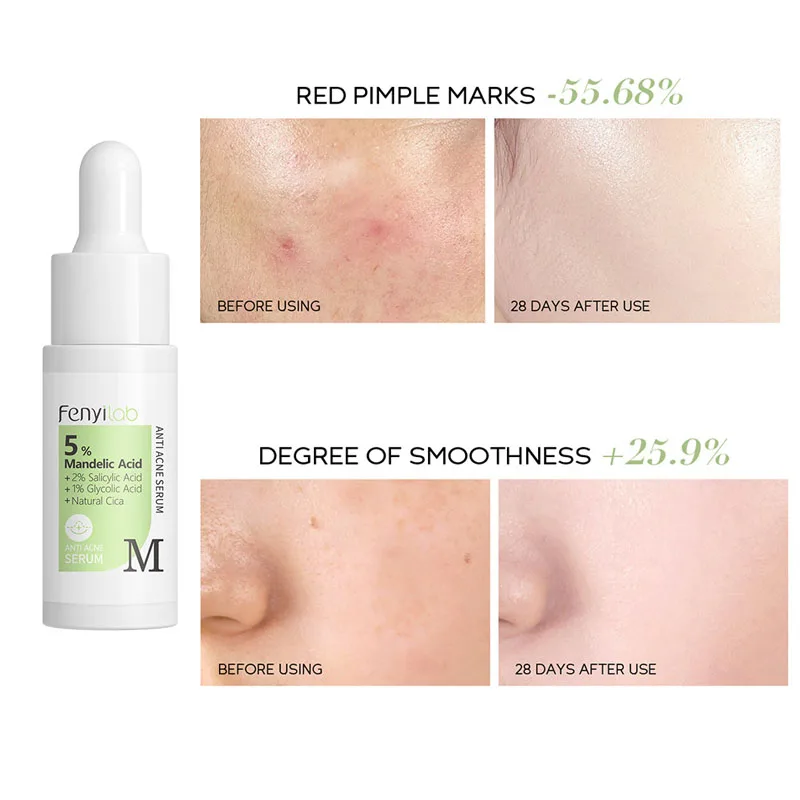 17ml Anti Aging Essence Shrink Pores Hyaluronic Acid Care Cosmetic Wrinkle Skin Retinol Serum Anti Face Nicotinamide Whitening
17ml Anti Aging Essence Shrink Pores Hyaluronic Acid Care Cosmetic Wrinkle Skin Retinol Serum Anti Face Nicotinamide Whitening