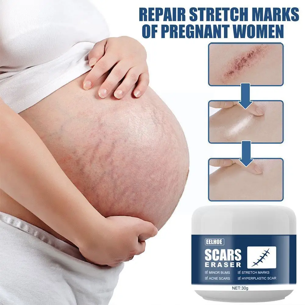 30g Scar Removal Cream Acne Scars Stretch Marks Surgical Remove Smoothing Care Skin Burn Body Scar Gel Z1w3
30g Scar Removal Cream Acne Scars Stretch Marks Surgical Remove Smoothing Care Skin Burn Body Scar Gel Z1w3