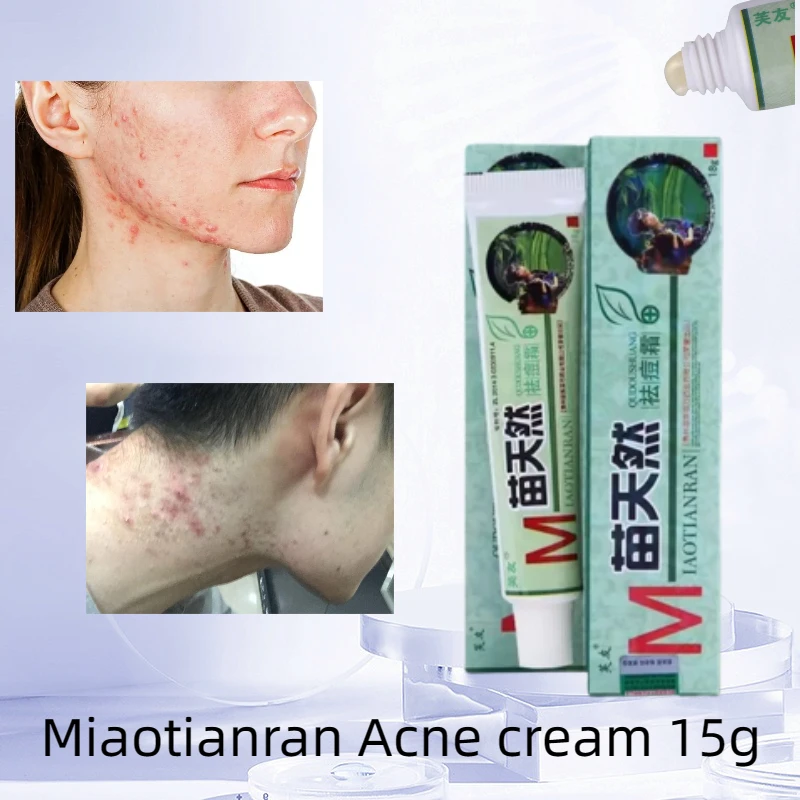 5 шт., антибактериальная мазь Fuyou против акне, 18 г
5 шт., антибактериальная мазь Fuyou против акне, 18 г