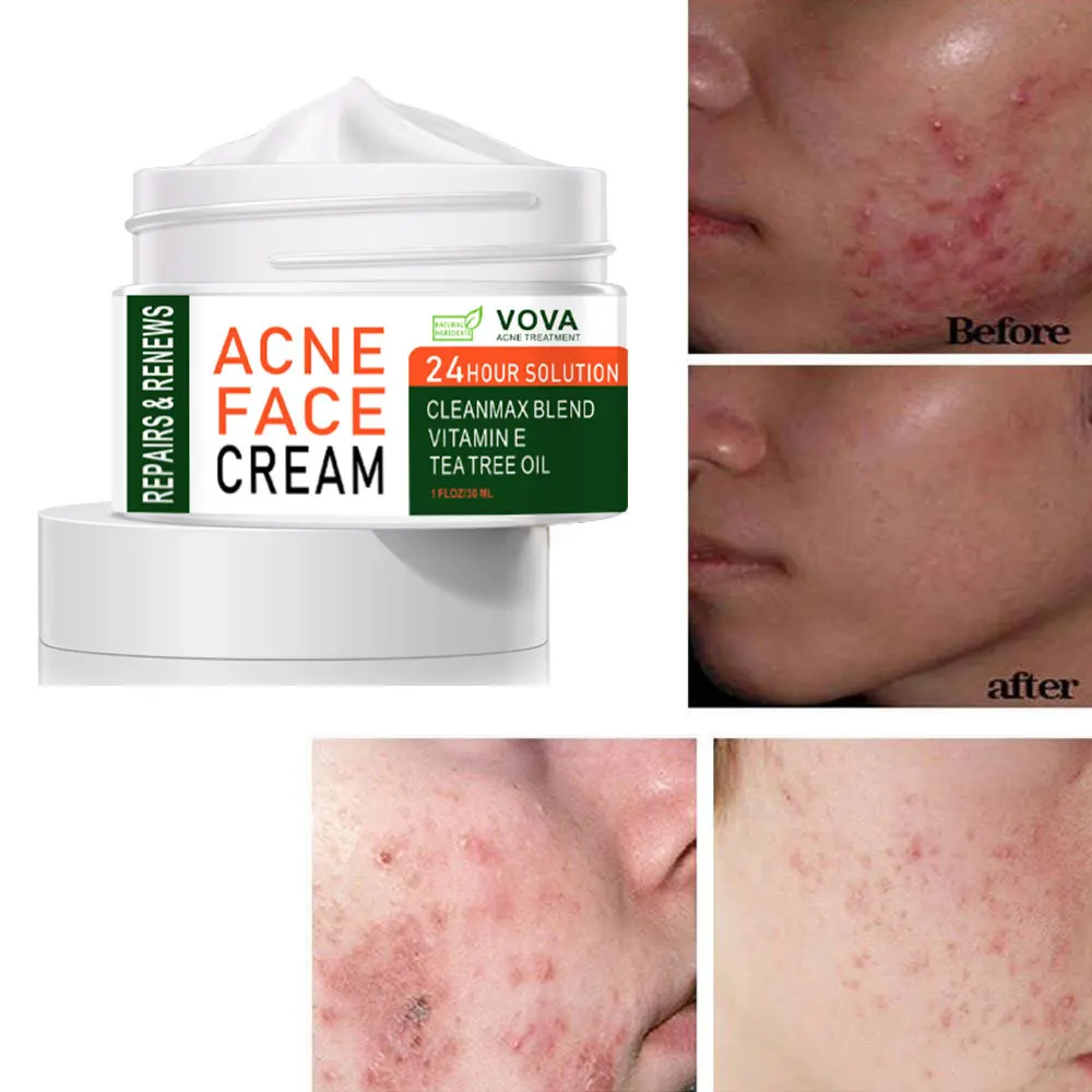 30g Acne Treatment Whitening Cream Blackhead Repair Gel Oil Control Shrink Pore Scars Moisturizing Korea Women Skin Care
30g Acne Treatment Whitening Cream Blackhead Repair Gel Oil Control Shrink Pore Scars Moisturizing Korea Women Skin Care