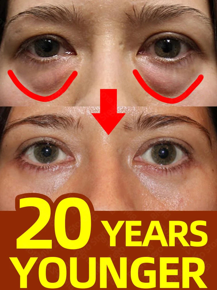 

Eye Cream Dark Circles Remove Bags Puffiness Away Work Under Eyes