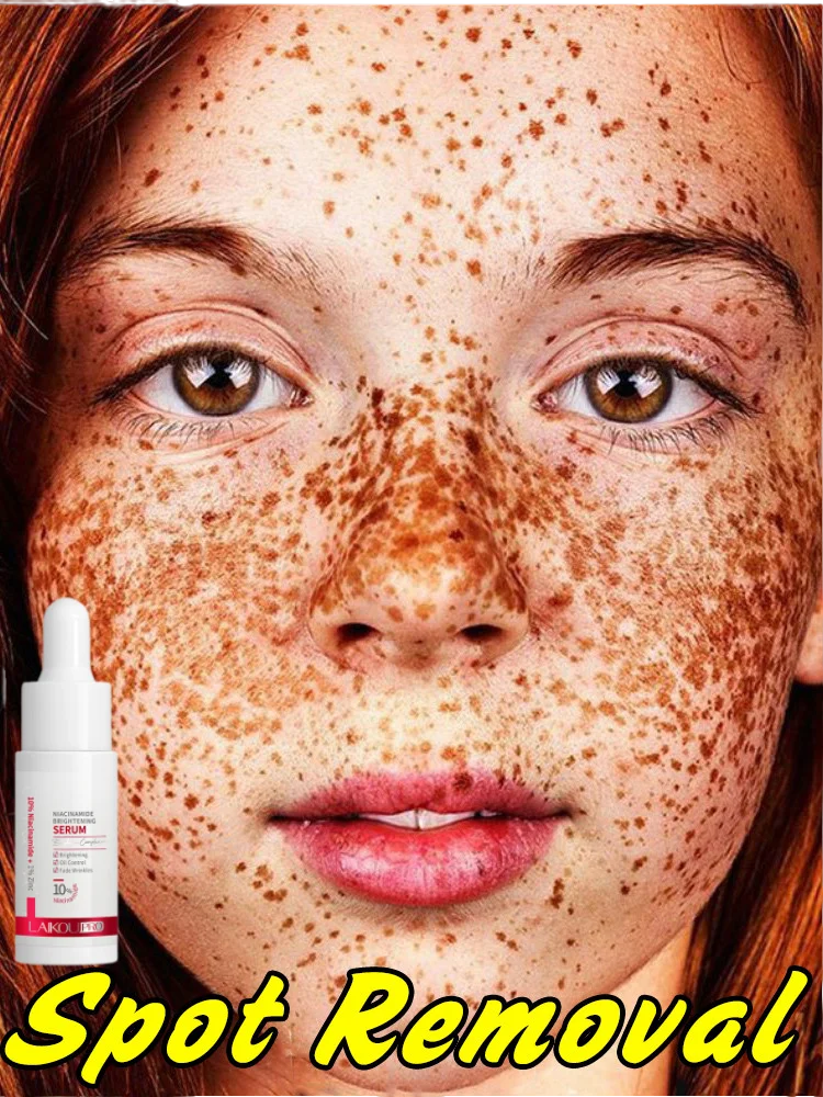 Fast Whitening Freckle Serum Remove Dark Spot Melasma Essence Anti-Aging Lighten Melanin Improve Dull Moisturize Korea Cosmetics
Fast Whitening Freckle Serum Remove Dark Spot Melasma Essence Anti-Aging Lighten Melanin Improve Dull Moisturize Korea Cosmetics