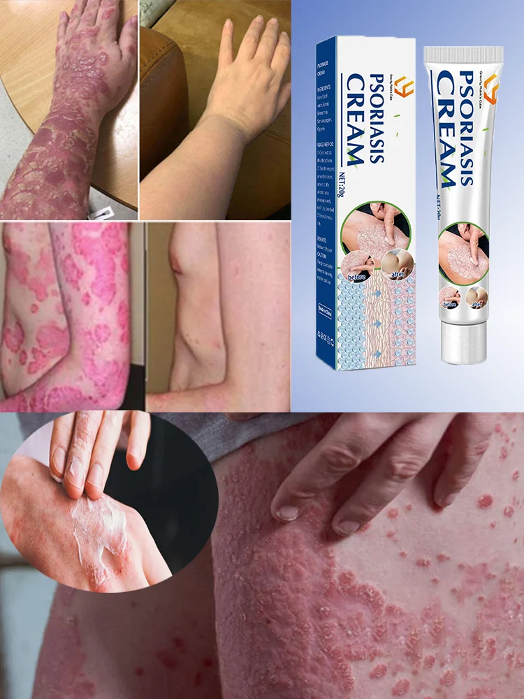Antibacterial Cream Psoriasis Cream Effective Antibacterial Hand Fungus Anti-Itch Dermatitis Fungus Inhibition
Antibacterial Cream Psoriasis Cream Effective Antibacterial Hand Fungus Anti-Itch Dermatitis Fungus Inhibition