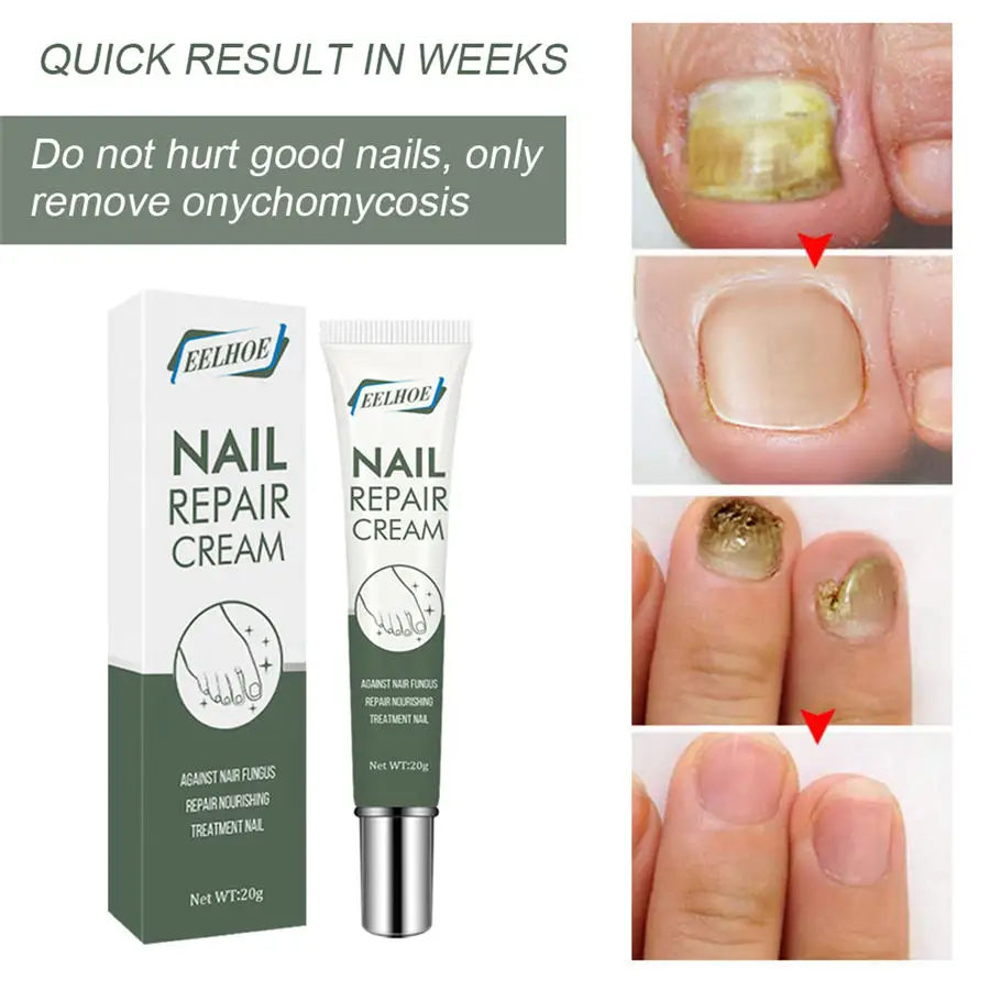 Nail Repair Cream Foot Care Nail Antibacterial Cream Thicken Nails Inhibit Fungus Onychomycosis Treatment Clean Soft Nail Creams
Nail Repair Cream Foot Care Nail Antibacterial Cream Thicken Nails Inhibit Fungus Onychomycosis Treatment Clean Soft Nail Creams