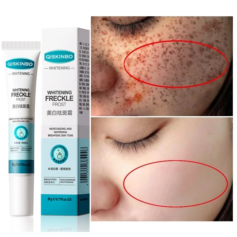 Для удаления темных пятен крем против веснушек, Ниацинамид, эффективное средство для восстановления кожи, антивозрастной увлажняющий крем для кожи
Для удаления темных пятен крем против веснушек, Ниацинамид, эффективное средство для восстановления кожи, антивозрастной увлажняющий крем для кожи