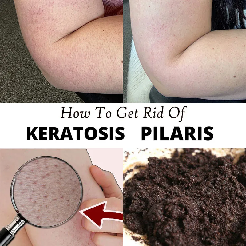 Exfoliating Scrub Fix Red Bumps on Chicken Arms Remove Keratosis Pilaris Chicken Skin Removal Dead Skin Remover Body Moisturizer
Exfoliating Scrub Fix Red Bumps on Chicken Arms Remove Keratosis Pilaris Chicken Skin Removal Dead Skin Remover Body Moisturizer