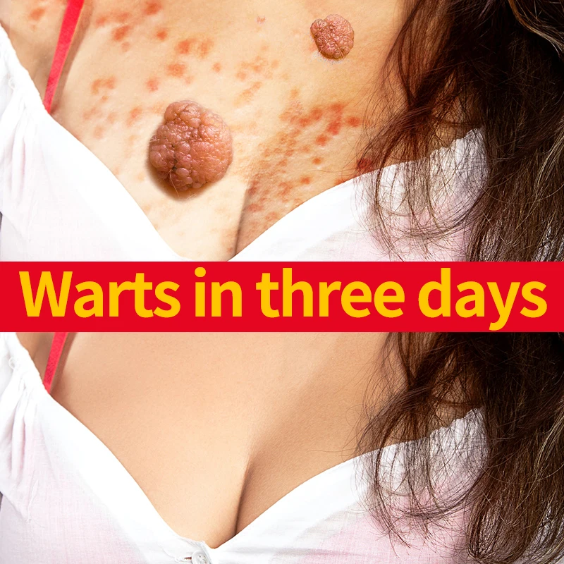 

Wart Removal Cream Flat Warts Quickly Get Rid of Skin Warts Natural Formula Painless Removal Safe Effective