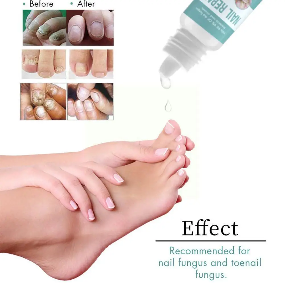 10ml Nail Fungus Therapy Foot Care Serum Fungal Nail Hand Onychomycosis Foot Toe Gel Removal Anti Foot Toes Nail Care Repai U9T3
10ml Nail Fungus Therapy Foot Care Serum Fungal Nail Hand Onychomycosis Foot Toe Gel Removal Anti Foot Toes Nail Care Repai U9T3