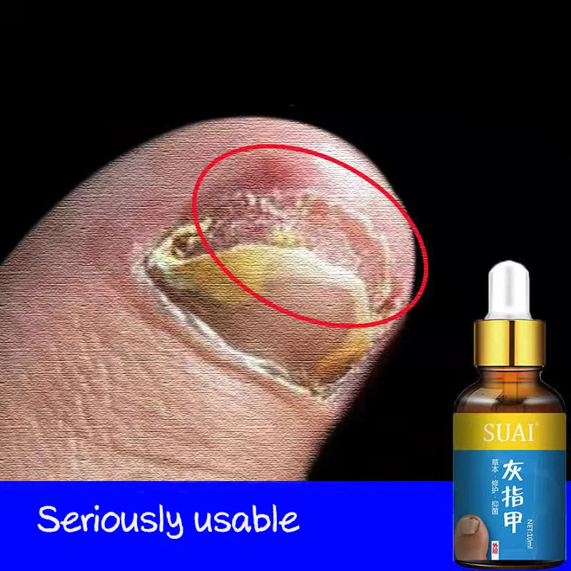 Средство для лечения грибков ногтей, эссенция для ухода за ногами, отбеливания ногтей и лечения ног, гель для удаления грибка, противоинфекц... 
Средство для лечения грибков ногтей, эссенция для ухода за ногами, отбеливания ногтей и лечения ног, гель для удаления грибка, противоинфекц...