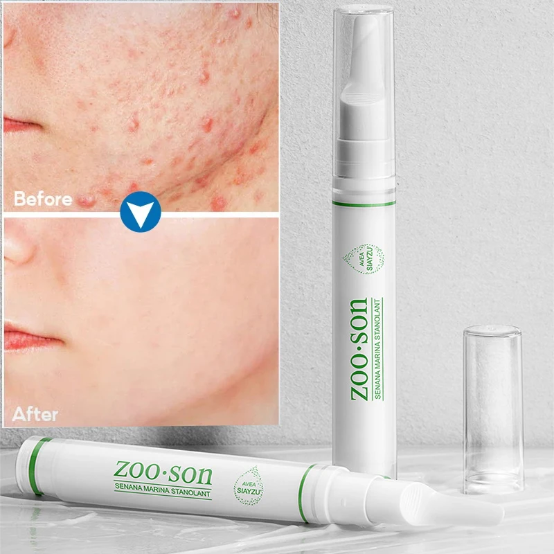 Salicylic Acid Acne Treatment Face Cream Anti-acne Gel Shrink Pores Moisturizing Whitening Repair Remove Blackheads Skin Care
Salicylic Acid Acne Treatment Face Cream Anti-acne Gel Shrink Pores Moisturizing Whitening Repair Remove Blackheads Skin Care