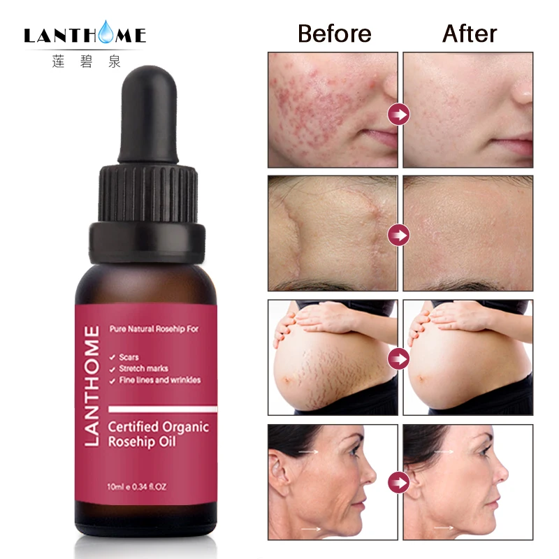 Rose Hip Oil Face Serum Fade Acne Mark Melanin Removal Improve Dull Lighten Facial Firming Skin Cosmetics
Rose Hip Oil Face Serum Fade Acne Mark Melanin Removal Improve Dull Lighten Facial Firming Skin Cosmetics
