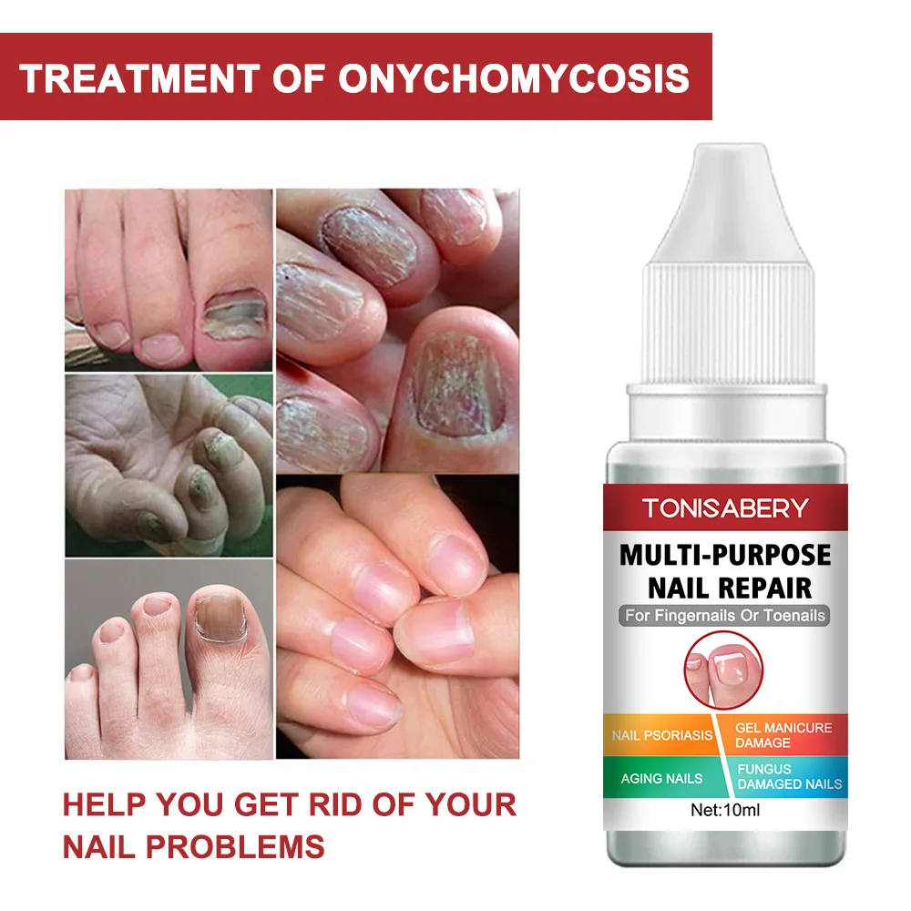Effective Nail Repair Cream Antifungal Infection Gel Nourish Nursing Onychomycosis Removal Paronychia Treatment Hand Foot Care
Effective Nail Repair Cream Antifungal Infection Gel Nourish Nursing Onychomycosis Removal Paronychia Treatment Hand Foot Care