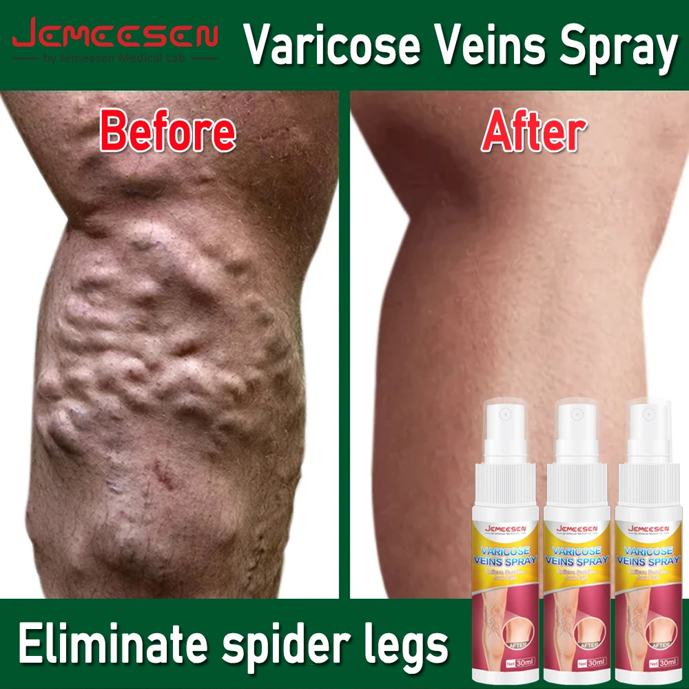 Jemeesen Varicose Veins Spray Pain Relieving Spray Relieve Vasculitis Phlebitis Pain Treatment Leg Angiitis Potent Remove Spray
Jemeesen Varicose Veins Spray Pain Relieving Spray Relieve Vasculitis Phlebitis Pain Treatment Leg Angiitis Potent Remove Spray