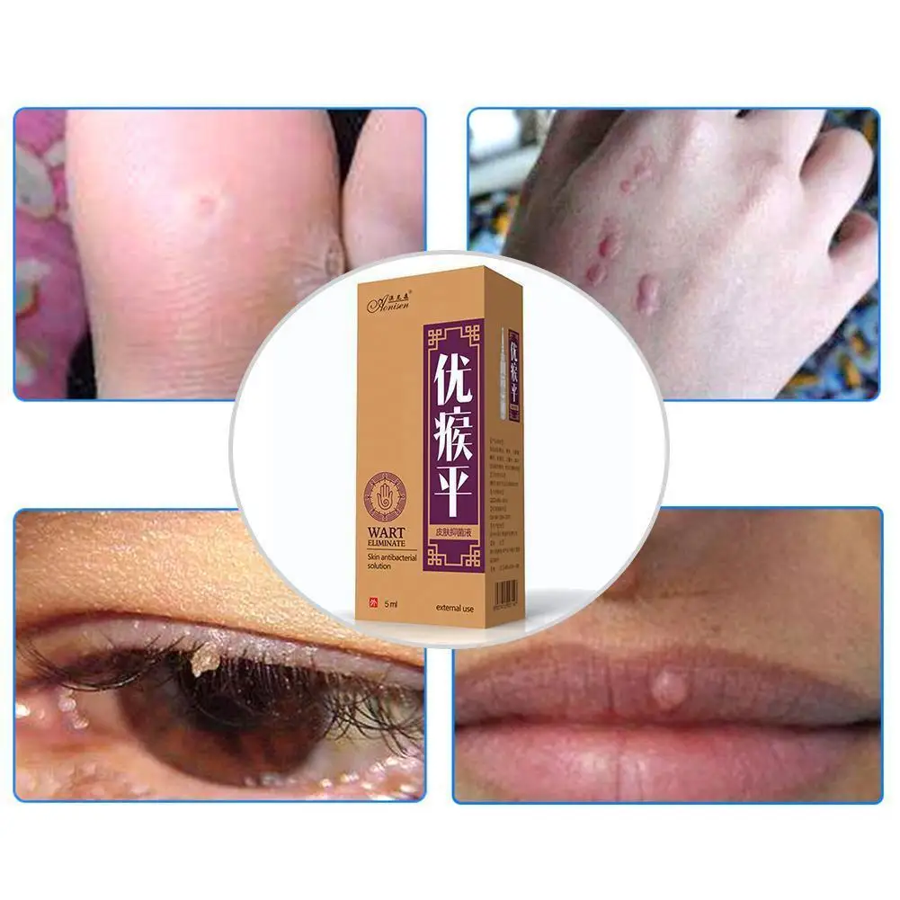 Skin Tag Remover Medical Against Moles Removal Genital Liquid Anti Foot Corn Wart Treatment Acne Care Spot Skin R2l3
Skin Tag Remover Medical Against Moles Removal Genital Liquid Anti Foot Corn Wart Treatment Acne Care Spot Skin R2l3