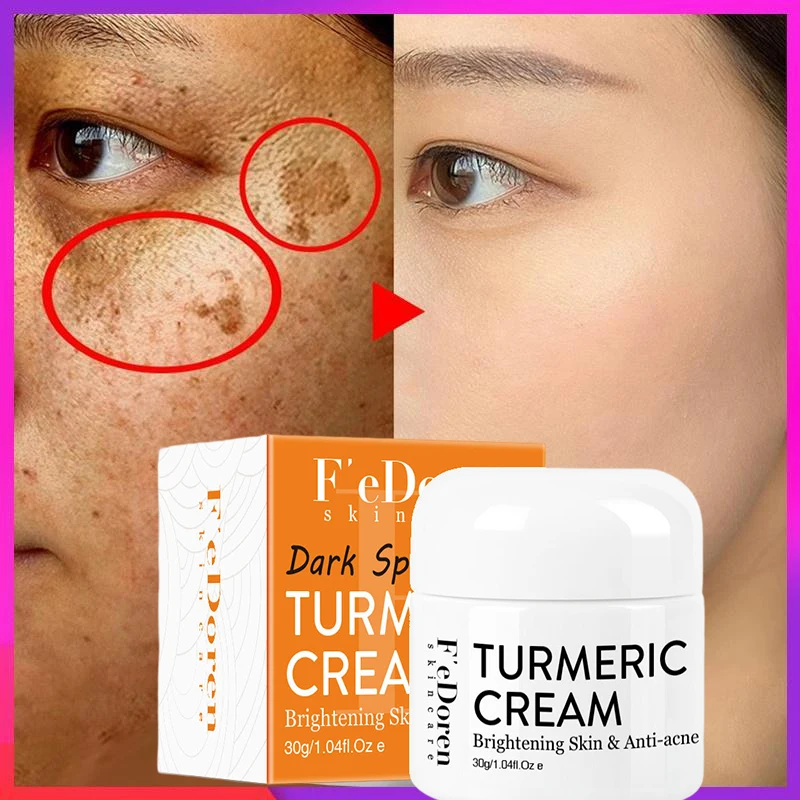 Whitening Turmeric Freckles Cream Fade Dark Spots Lighten Remove Melanin Melasma Anti Aging Moisturizing Brighten Face Skin Care
Whitening Turmeric Freckles Cream Fade Dark Spots Lighten Remove Melanin Melasma Anti Aging Moisturizing Brighten Face Skin Care