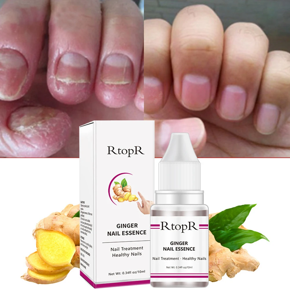RtopR Nail Fungal Treatment Feet Care Essence Nail Foot Care Toe Nail Fungus Removal Gel Anti Infection Paronychia Repair Gel
RtopR Nail Fungal Treatment Feet Care Essence Nail Foot Care Toe Nail Fungus Removal Gel Anti Infection Paronychia Repair Gel