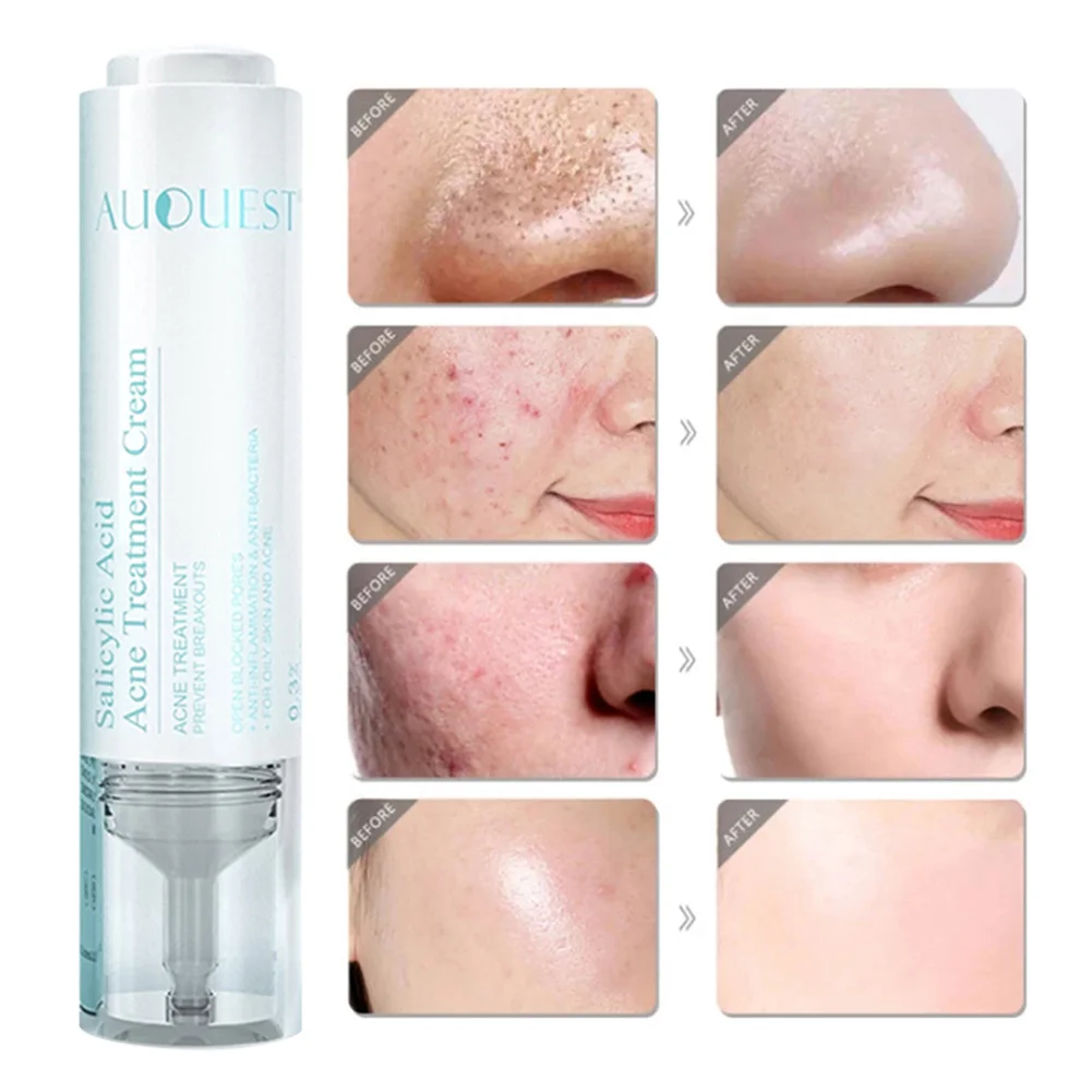 15ML Salicylic Acid Acne Treatment Cream Repair Acne Skin Oil Control Shrink Pores Skin Moisturizing Repairing Cream Skin Care
15ML Salicylic Acid Acne Treatment Cream Repair Acne Skin Oil Control Shrink Pores Skin Moisturizing Repairing Cream Skin Care