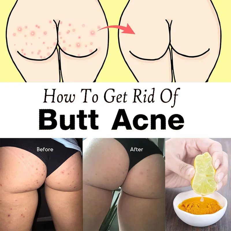 Turmeric Antibacterial Soaps Get Rid of Butt Acne Anti-inflammatory Antiseptic Fix Folliculitis Salicylic Acid Dead Skin Remover
Turmeric Antibacterial Soaps Get Rid of Butt Acne Anti-inflammatory Antiseptic Fix Folliculitis Salicylic Acid Dead Skin Remover