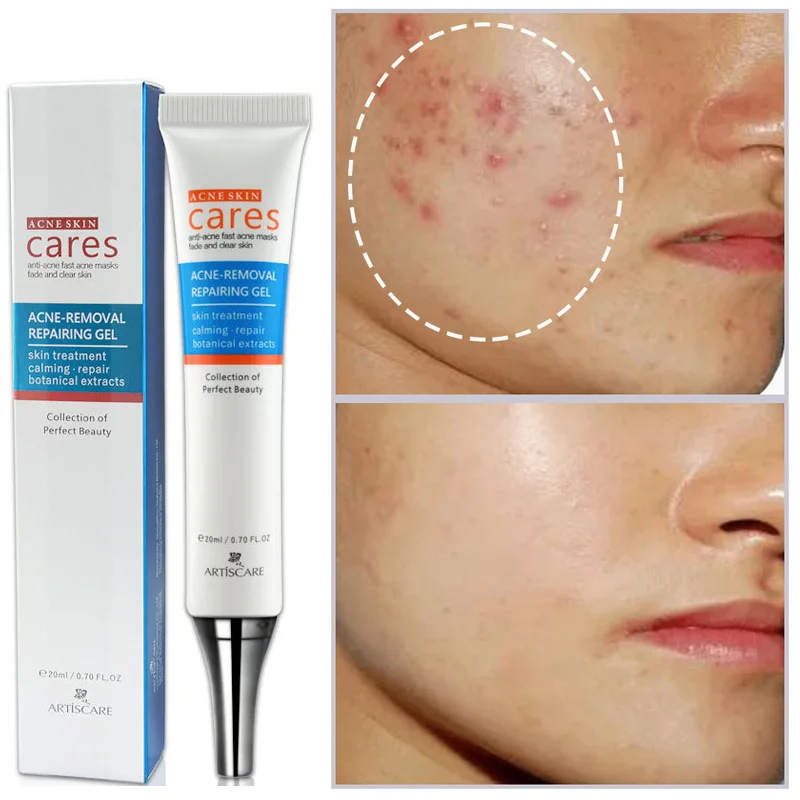 Acne Treatments Face Cream Acne Spots Removal Gel Oil Control Fade Scar Shrink Pores Whitening Moisturizing Skin Care Products
Acne Treatments Face Cream Acne Spots Removal Gel Oil Control Fade Scar Shrink Pores Whitening Moisturizing Skin Care Products