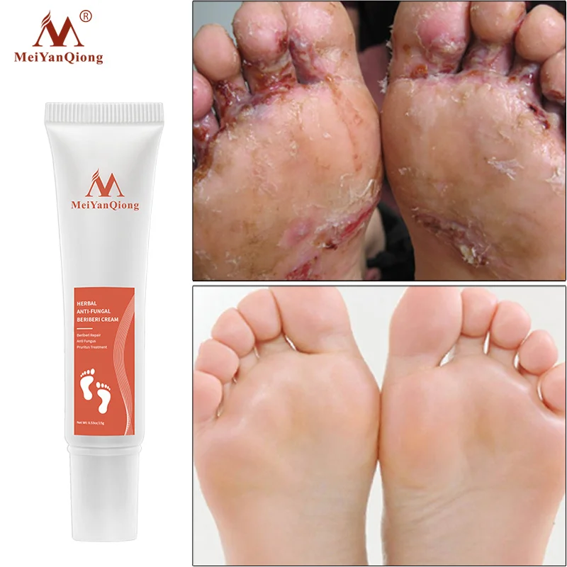 Herbal Foot Cream Nail Fungus Removal Cream Effective Anti Fungal Infection Onychomycosis Treatment Toe Fungus Repair Feet Care
Herbal Foot Cream Nail Fungus Removal Cream Effective Anti Fungal Infection Onychomycosis Treatment Toe Fungus Repair Feet Care