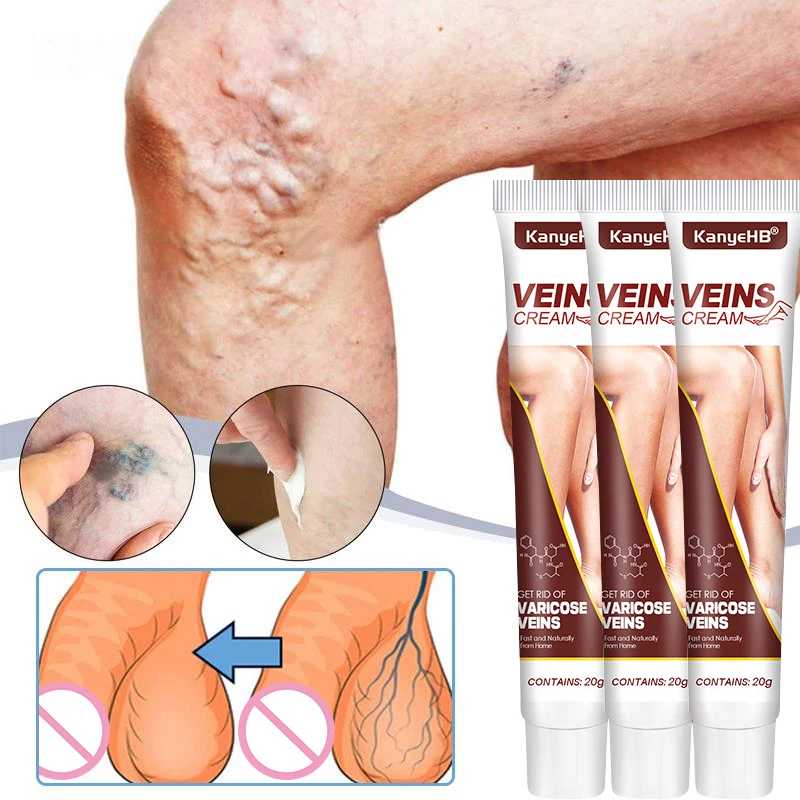 Buy3 get2 off Varicose Veins Cream Varicocele Vasculitis Phlebitis Spider Shape Vein Swell Pain Relieve Herbal Ointment
Buy3 get2 off Varicose Veins Cream Varicocele Vasculitis Phlebitis Spider Shape Vein Swell Pain Relieve Herbal Ointment