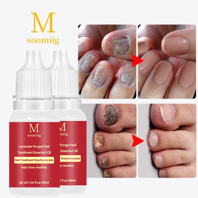 Fungal nail care essential oil is used to treat infectious paronychia. Nail repair essential oil enhances nail repair function
Fungal nail care essential oil is used to treat infectious paronychia. Nail repair essential oil enhances nail repair function